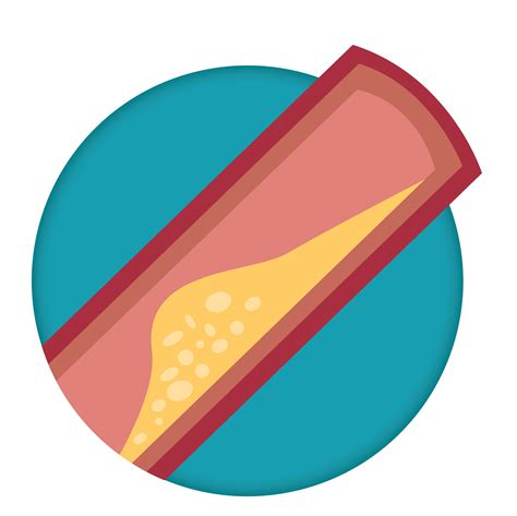 Coronary Artery Disease | CardioSmart – American College of Cardiology