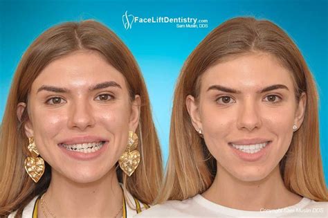 Before And After Photos Showing Underbite Correction Overbite