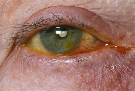 Corneal Ulcer Stock Image M1550492 Science Photo Library