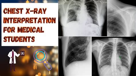 Chest X Ray Interpretation For Medical Students Abcde Approach Youtube