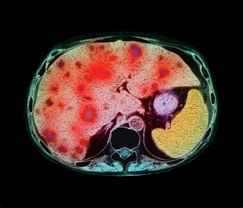 Liver Cancer Ct Scan Photograph By Simon Fraserfreeman Hospital