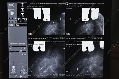 Mammography Result Stock Image C0152247 Science Photo Library