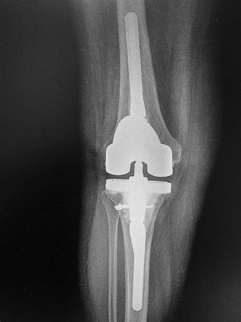Revision Total Knee Replacement Dr Sunil Reddy