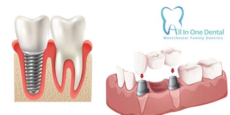 Dental Implants Vs Crowns Which Is Better All In One Dental Los
