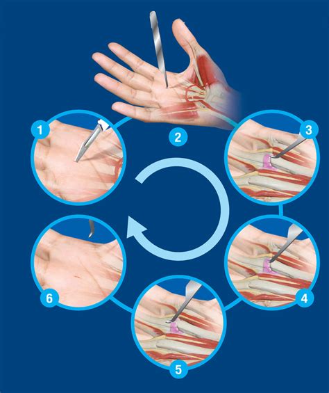The Surgical Technique Of Percutaneous Release Trigger Finger Using The