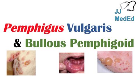 Vesiculobullous Skin Diseases Pemphigus Vulgaris Vs Bullous