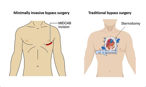 Minimally Invasive Bypass Surgery