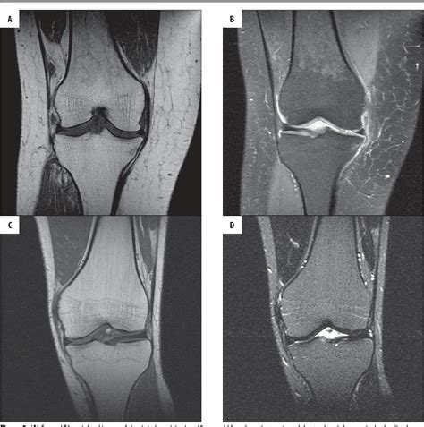 Bone Marrow Reconversion Imaging Of Physiological Changes In Bone