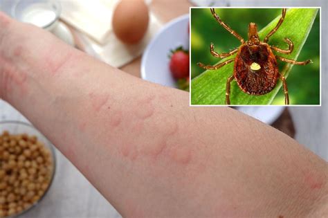 Mystery Illness From Tick Bites Leads To Rare Red Meat Allergy Crumpe