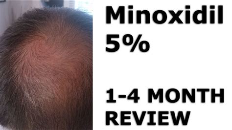 Minoxidil Hair Regrowth Before And After 1 4 Months Youtube