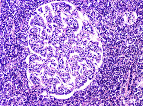 Glucagon Cell Adenomatosis A New Entity Associated With Necrolytic