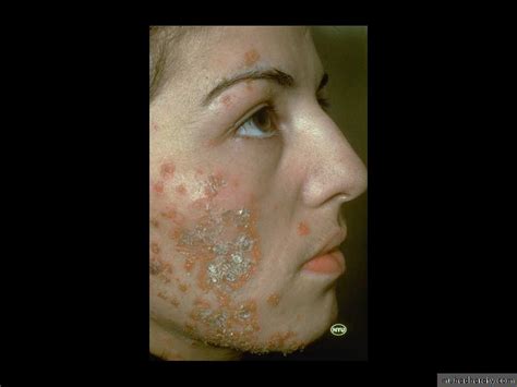 Bacterial Skin Infections Pptx دسلام التميمي Muhadharaty