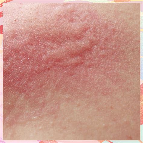 Suffer From Itchy Skin An Expert Reveals Everything You Need To Know