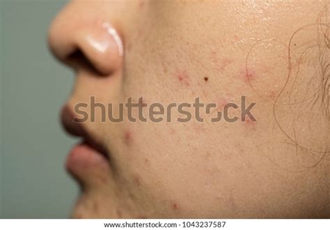 Acne Skin Because Disorders Sebaceous Glands Stock Photo 1043237587