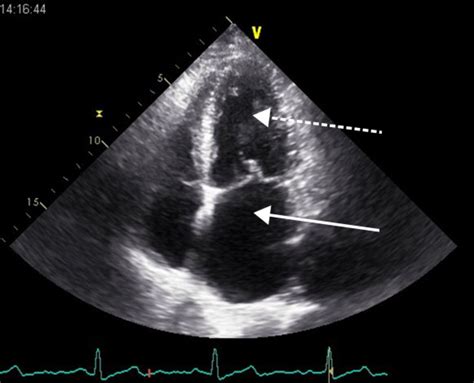 Echocardiogram Of Heart Failure