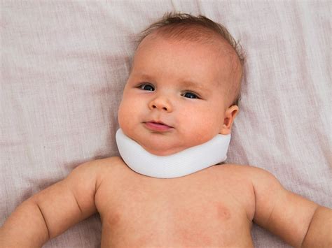 Torticollis A Consequence Of Neonatal Abstinence Syndrome