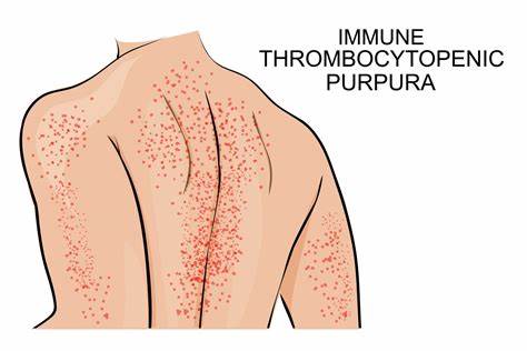 Тромбоцитопеническая пурпура диета Purpura Thrombopénique Immunologique - La Santé Au Quotidien Purpura Thrombopénique Immunologique - La Santé Au Quotidien Тромбоцитопеническая пурпура диета