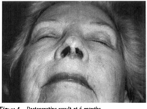 Figure From The Nasal Floor Transposition Flap For Repairing Distal