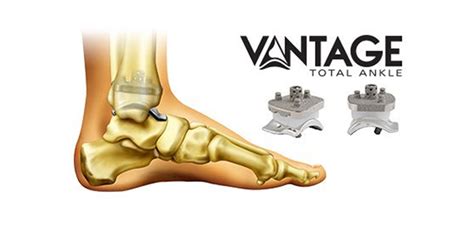 Exactech First Surgery With Vantage Total Ankle System Orthopedics