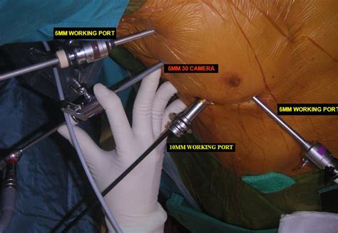 Video Assisted Thoracoscopic Vats Thymectomy Ctsnet