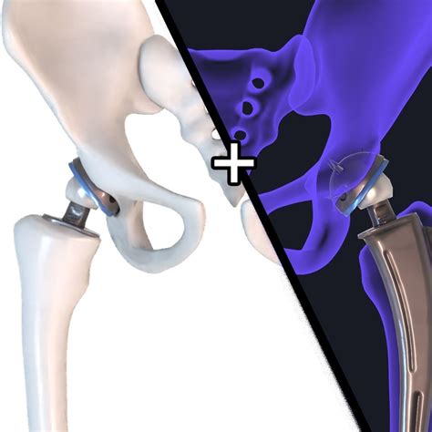 Finally, red bone marrow stores some iron in the form of the molecule ferritin and uses this iron to form hemoglobin in red blood cells. 3D model Hip replacement implant installed in the pelvis 1