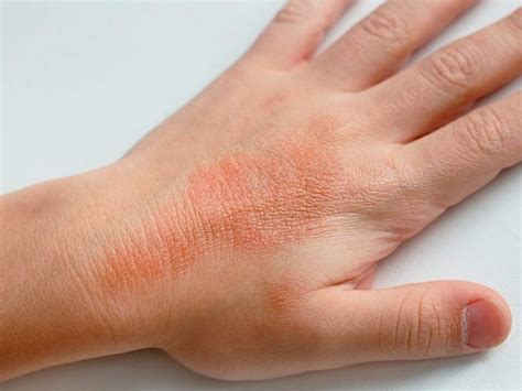 Atopic Dermatitis An Incurable Skin Disease Healthy Life Blog