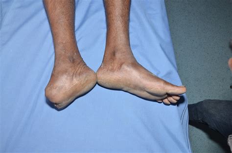 Traumatic Amputation Of Midfoot Crush Injury Foot Lower Limb
