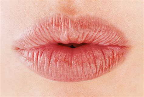 Cause Dry Lips Vitamin Deficiency