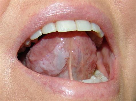 Leukoplakia Causessymptomstreatments Oral Cancer Medegurumed E Guru