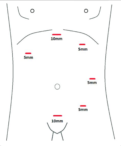 Schematic Diagram Of Port Placement Used For Laparoscopic Etep Repair