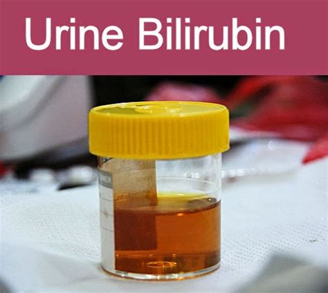 Medical Laboratory And Biomedical Science Urine Bilirubin