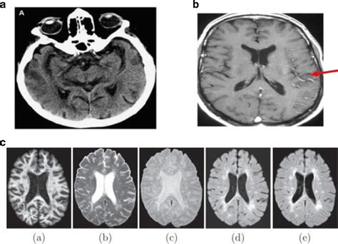 A Unenhanced Ct With Transient Ischemic Attacks In Left Side B Mri