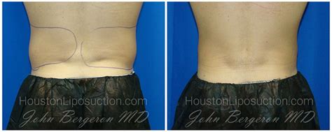 Male Love Handle Liposuction Before And After