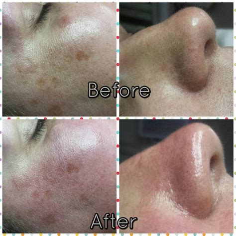 Microdermabrasion Before And After SkinBase Facial