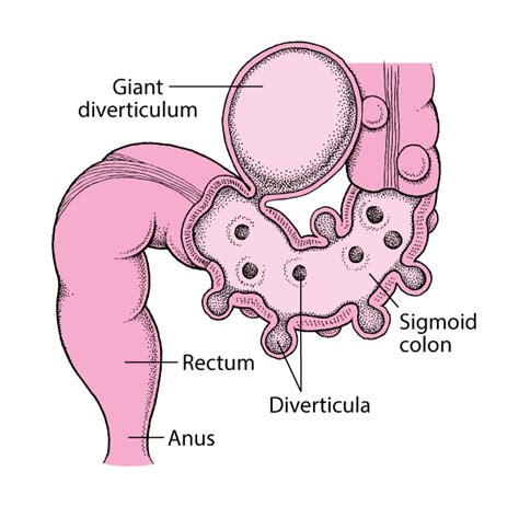 Diverticulosis Of The Large Intestine Digestive Disorders Msd