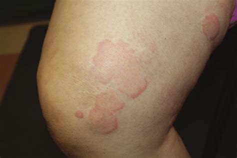 Typical Urticarial Plaques Are Observed On The Leg Of The Patient