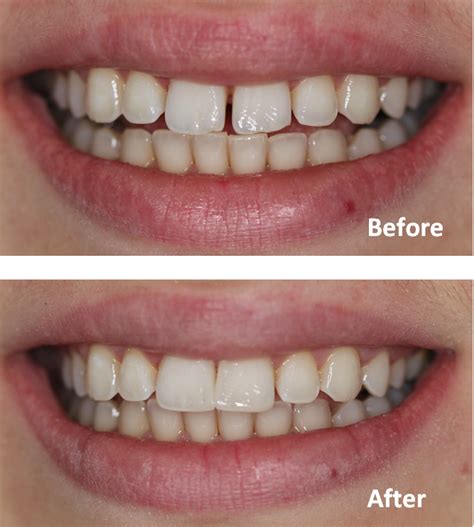 While orthodontic braces are one method we use to close gaps, you'll be pleased to know that there are several other methods we can use depending. dentael: Dentist in Ealing, Greenford I Dental Care Clinic ...