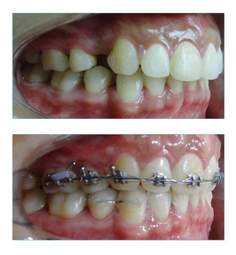 Espaços Difíceis De Fechar Em Ortodontia