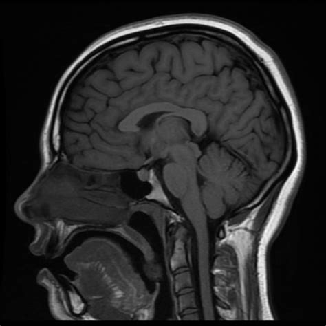 Normal Brain Mri Image