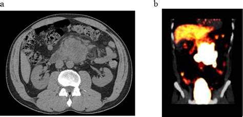 Figure 3 From Histological Transformation In Duodenal Type Follicular