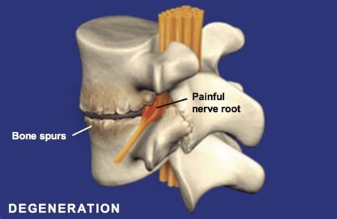 Spondylosis Degeneration Of The Spine Florida Surgery Consultants