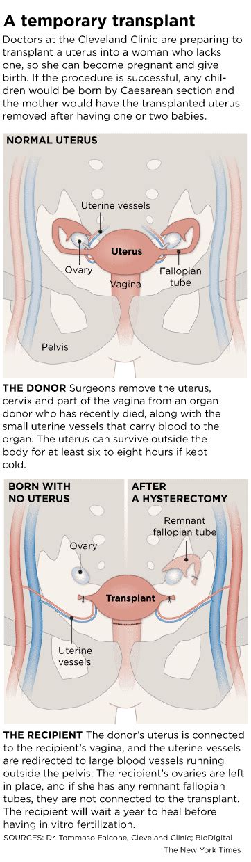 First Uterus Transplant In Us Planned In Cleveland Dallas Morning News