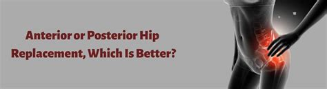 Anterior Or Posterior Hip Replacement Which Is Better