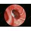 Endoscopic Image Of A Bleeding Peptic Ulcer  Stock M280/0031