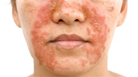 Skin Rashes On Face