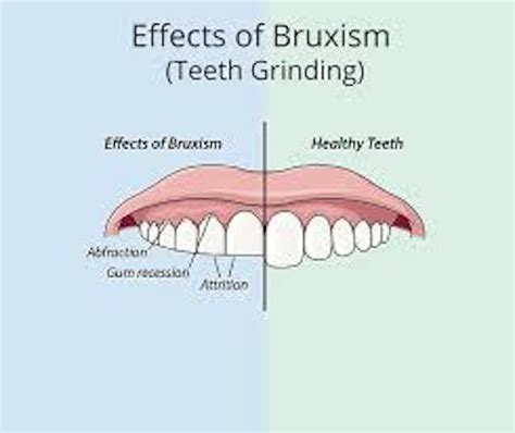 Bruxism Teeth Grinding Maritza O Jenkins Dmd General Dentist
