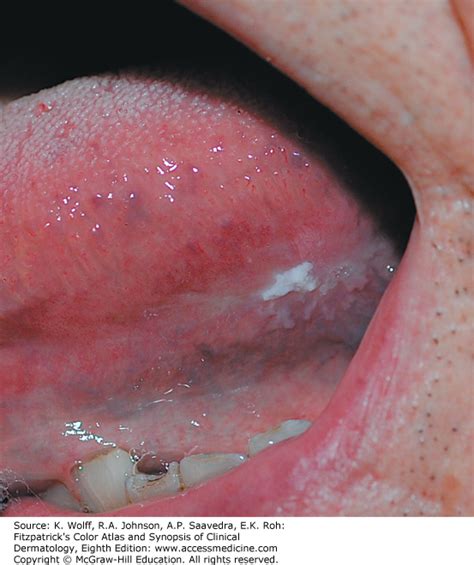 Icd 10 Code For Abscess To Cheek In Mouth