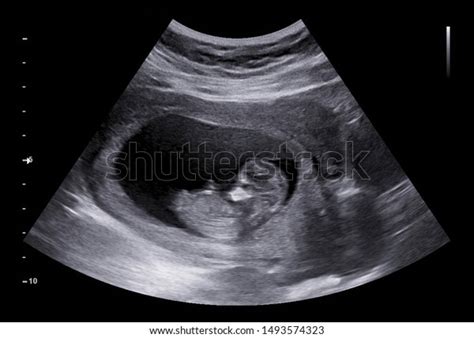 Ultrasound Small Baby 12 Weeks 12 Stock Photo Edit Now 1493574323