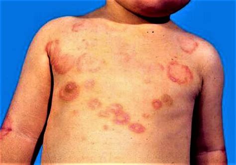 Rheumatic Fever Causes Signs Symptoms Complications And Treatment