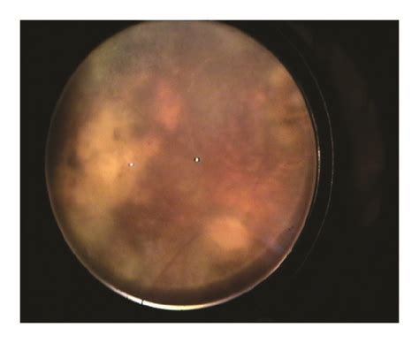 Color Fundus Images Of The Eye A Periphlebitis And Vascular